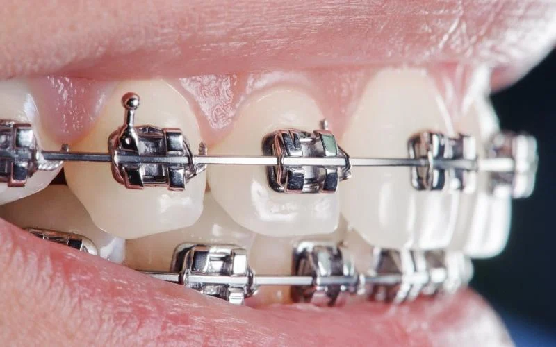 Advantages of Self-Ligating Braces Cosmic Dental Clinic